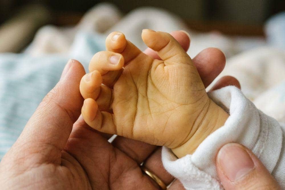 Penyebab Bayi Baru Lahir Masih Kuning setelah Keluar dari RS 5
