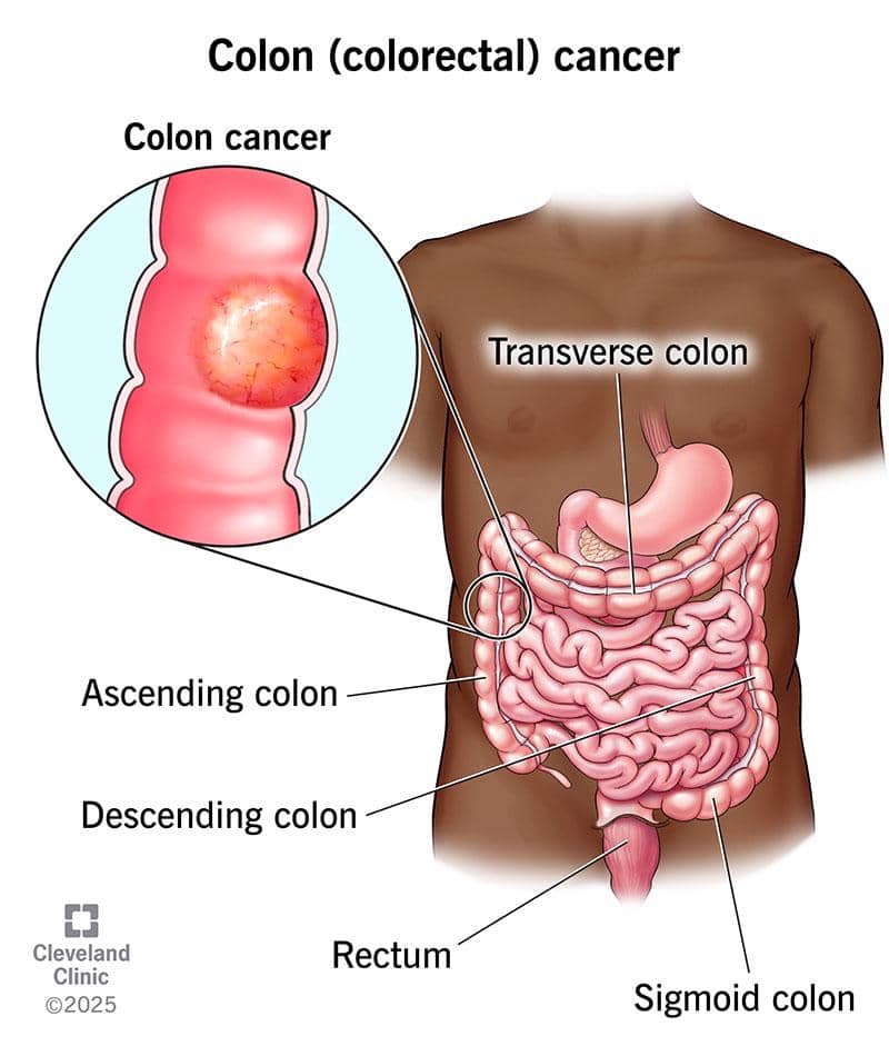 ilustrasi colorectal cancer