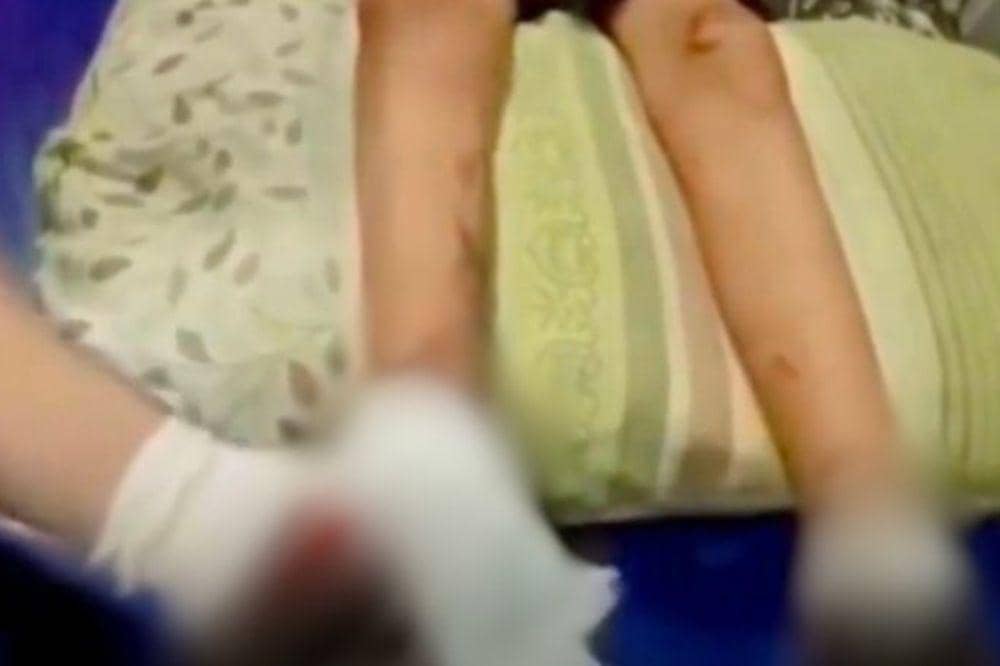Tragis, Kaki Siswi SD di Inhil Menghitam usai Diduga Jadi Korban Bully
