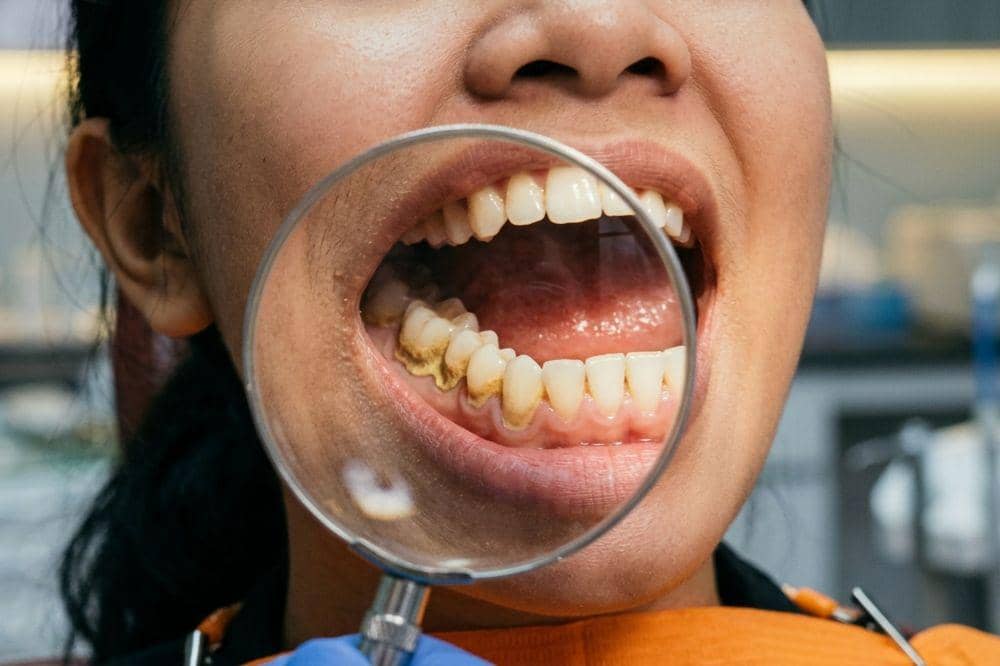 Benarkah Karang Gigi Bisa Menyebabkan Keguguran?