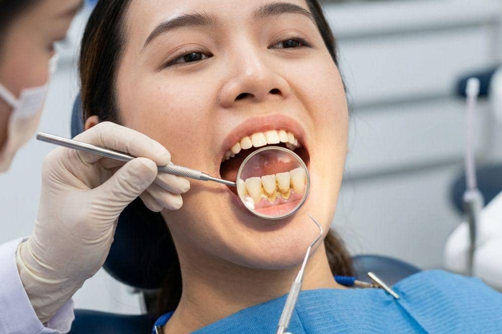 Benarkah Karang Gigi Bisa Menyebabkan Keguguran?