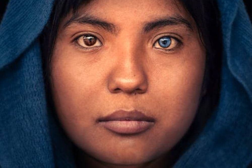 Apa Itu Mata Heterochromia? Kenali Penyebab dan Cara Menyembuhkannya