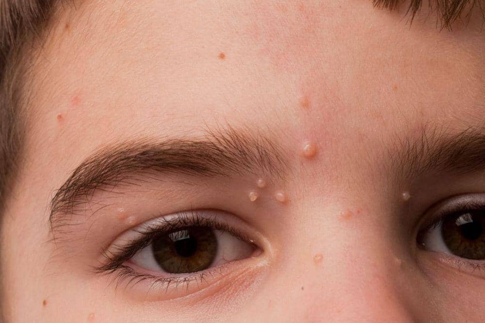 Apa Itu Molluscum Contagiosum, Infeksi Kulit Anak yang Menular