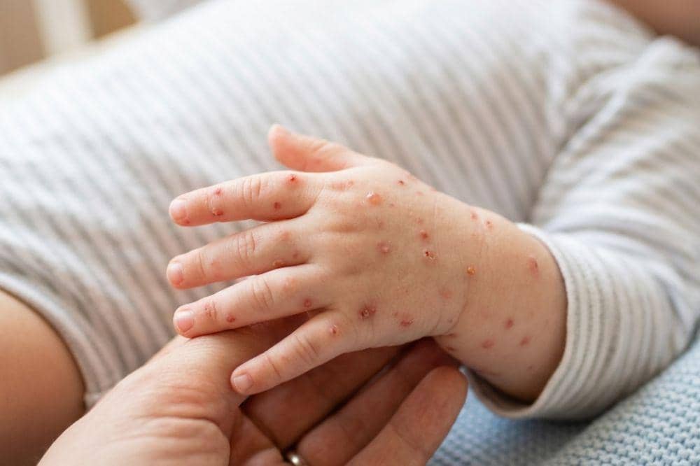 Vaksin Anak yang Tidak Ditanggung Pemerintah tapi Penting untuk si Kecil