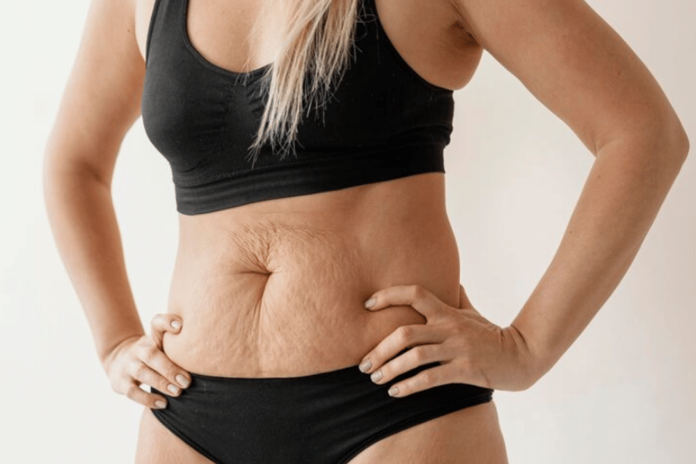 7 Skincare Pasca Melahirkan Terbaik untuk Stretch Marks dan Payudara 