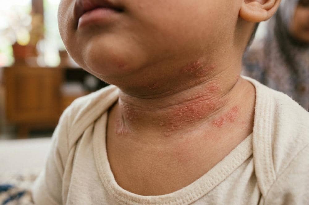 Bayi Bisa Terkena Eksim Walau Orangtua Tidak Punya Riwayat Alergi