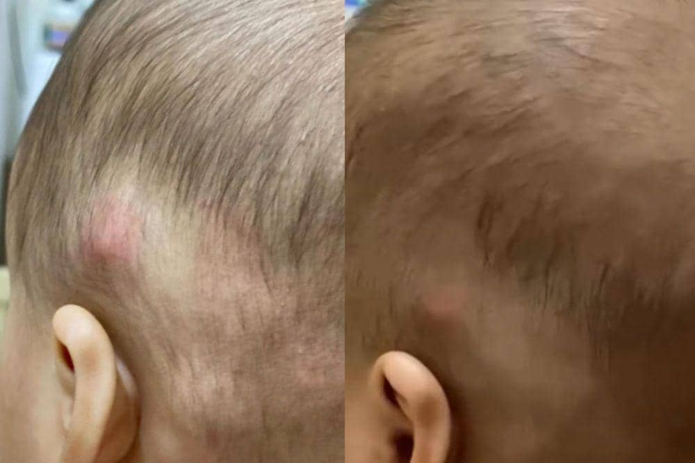 Ada Benjolan di Belakang Telinga dan Leher Anak? Ini Penjelasan Dokter