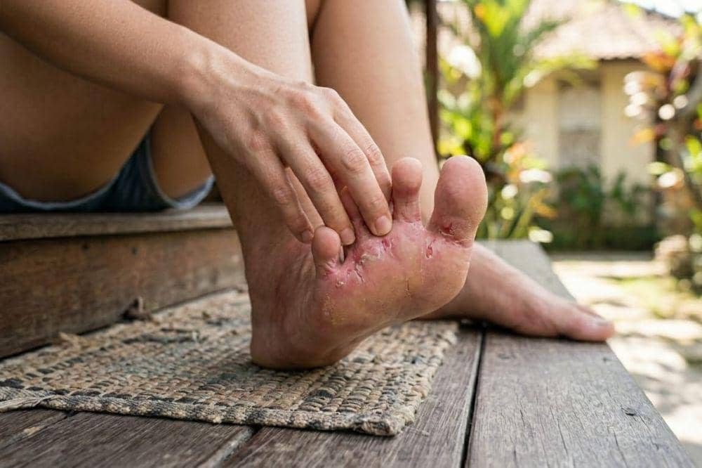 Penyebab Gatal di Sela Jari Kaki 3.jpg