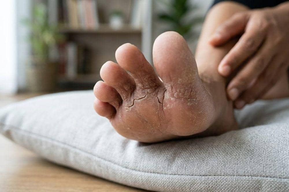 Penyebab Gatal di Sela Jari Kaki 6.jpg
