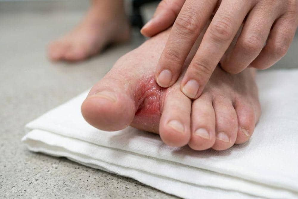 Penyebab Gatal di Sela Jari Kaki 4.jpg