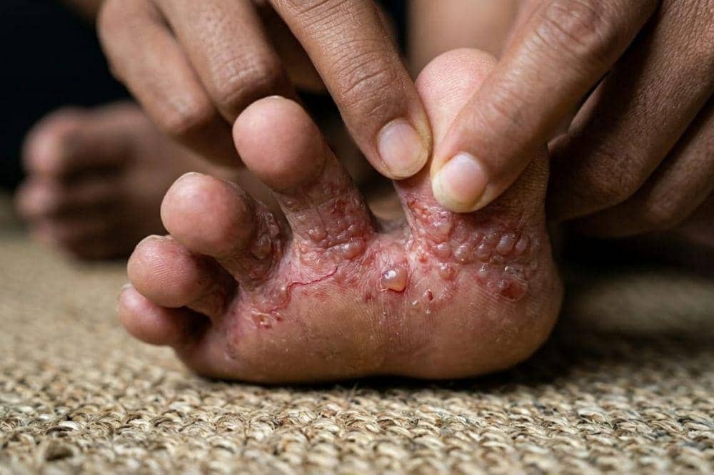 Penyebab Gatal di Sela Jari Kaki 5.jpg