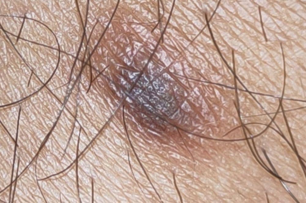 Dermatofibroma_ Definisi, Penyebab, dan Cara Pencegahannya 2.jpg