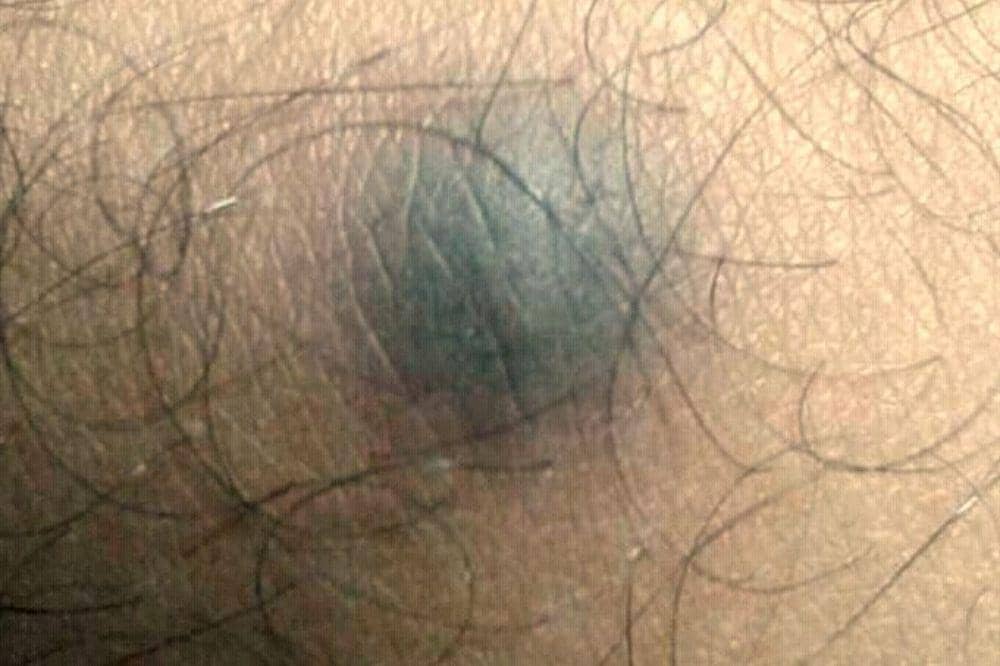 Mengenal Dermatofibroma: Definisi, Penyebab, dan Cara Pencegahannya