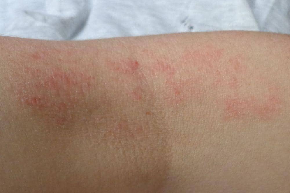 Apakah Dermatitis Bisa Sembuh_ 6.jpg