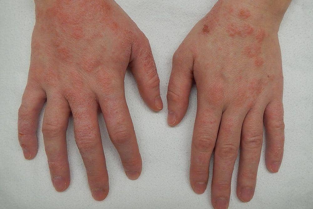 Apakah Dermatitis Bisa Sembuh_ 3.jpg