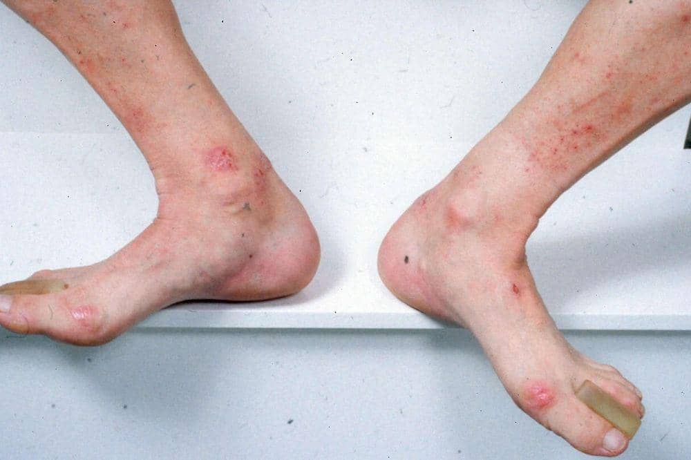 Apakah Dermatitis Bisa Sembuh_ 5.jpg