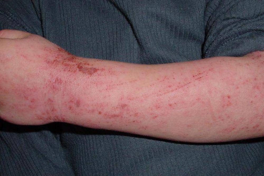 Apakah Dermatitis Bisa Sembuh_ 2.jpg