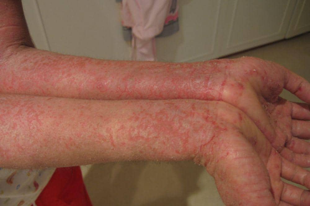 Apakah Dermatitis Bisa Sembuh_ 4.jpg