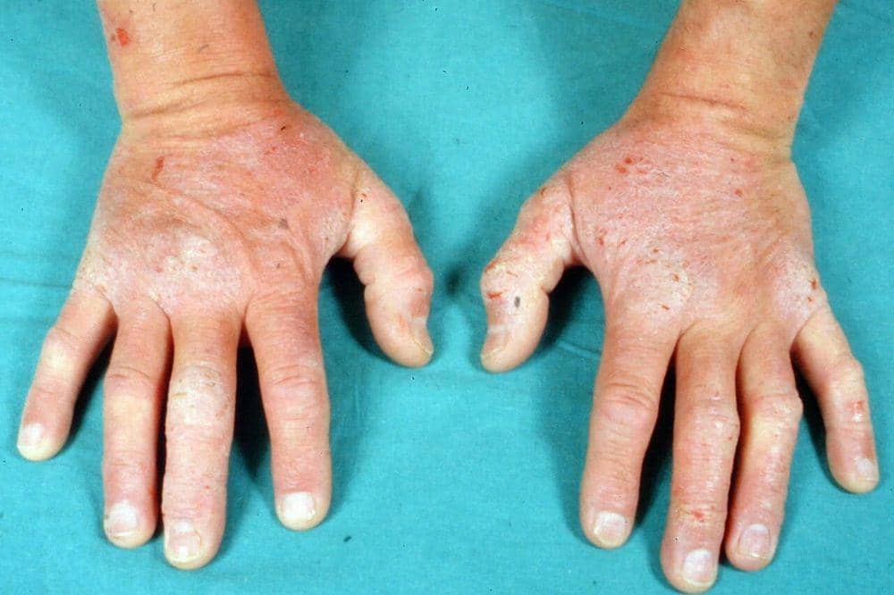 Apakah Dermatitis Bisa Sembuh? Ini Penjelasan dan Penanganannya