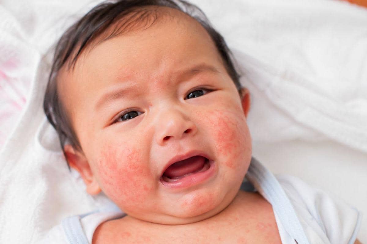 Apakah hati ayam merupakan alergen umum untuk bayi?