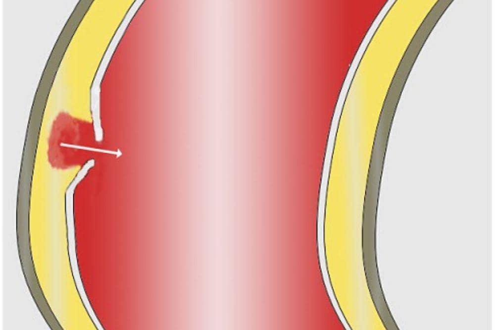 Apa Itu Penyakit Diseksi Aorta_ 2.jpg