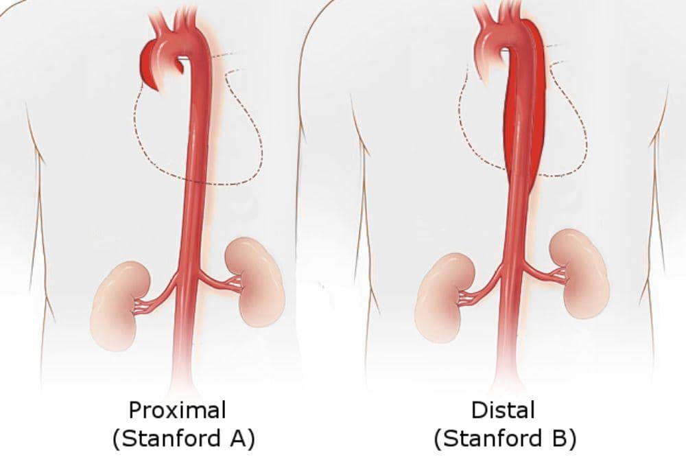 Apa Itu Penyakit Diseksi Aorta_ 3.jpg