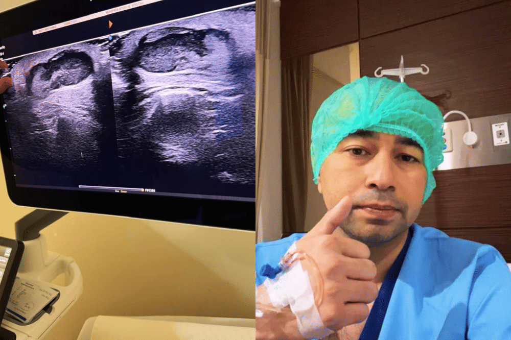 Apa Itu Lipoma? Benjolan yang Ada di Bahu Raffi Ahmad (2).png