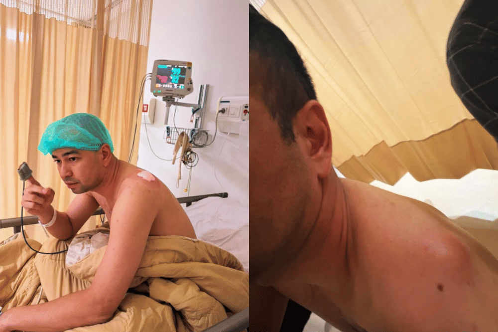 Apa Itu Lipoma? Benjolan yang Ada di Bahu Raffi Ahmad