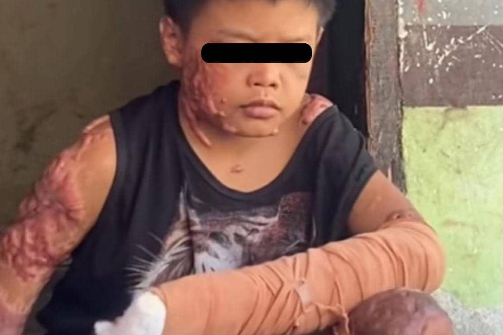 anak korban bully dibakar di NTB