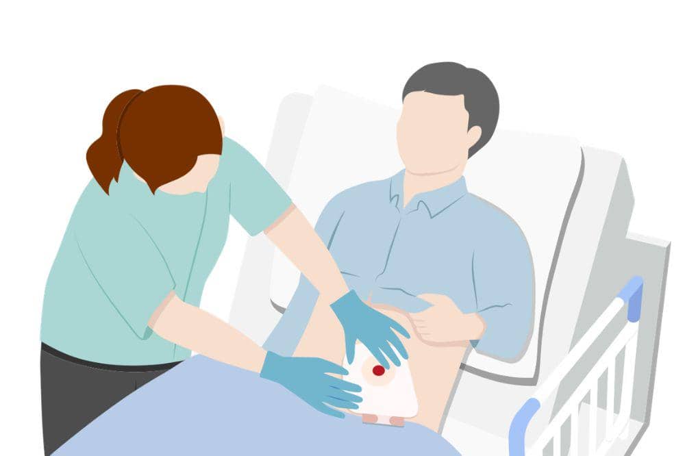 Stoma_ Apa Itu, Penyebab, Gejala,dan Pengobatan 2
