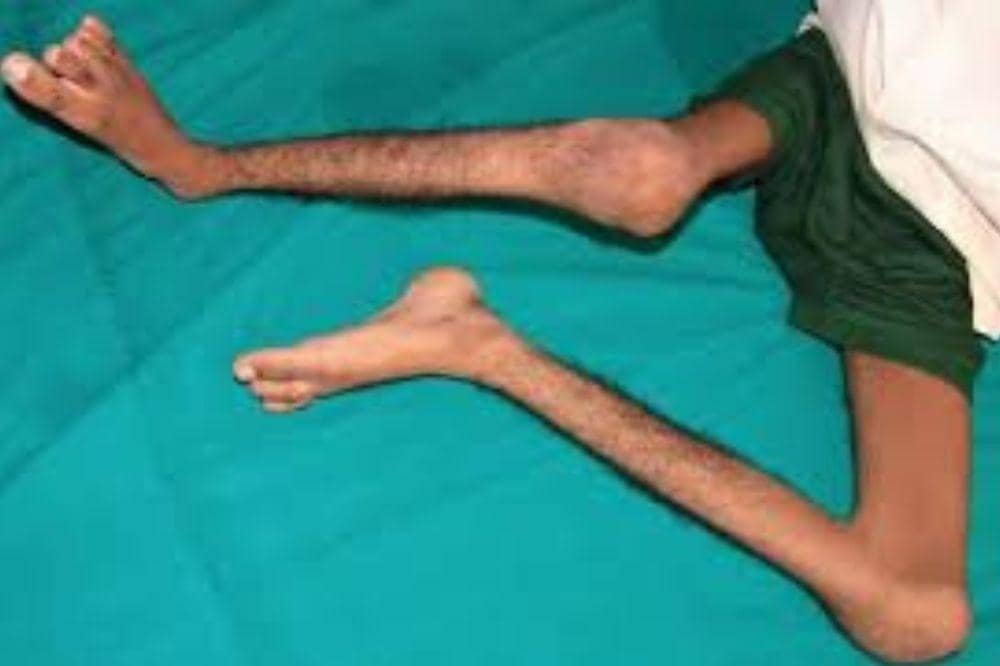 Polio merupakan penyakit infeksi akibat serangan virus yang menyerang anak-anak usia di bawah 5 tahun