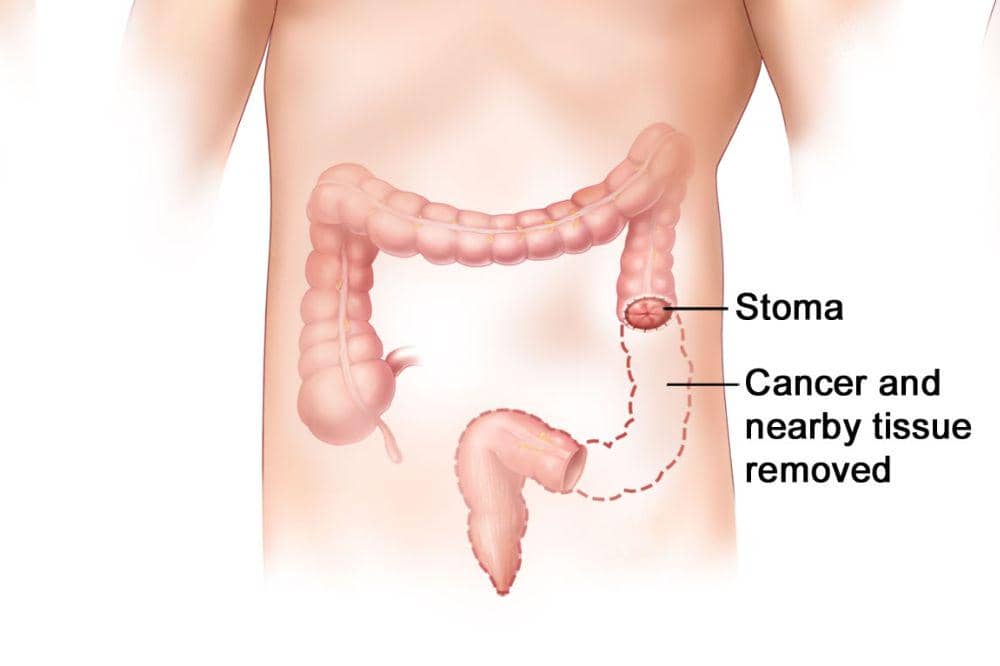 Stoma_ Apa Itu, Penyebab, Gejala,dan Pengobatan 3