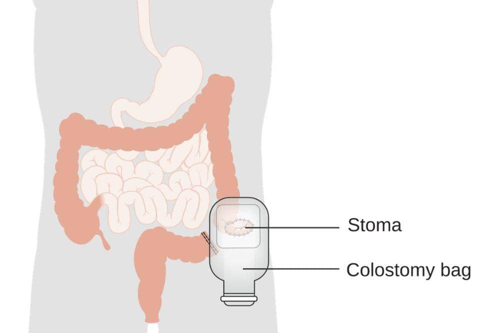 Stoma: Apa Itu, Penyebab, Gejala, dan Pengobatan