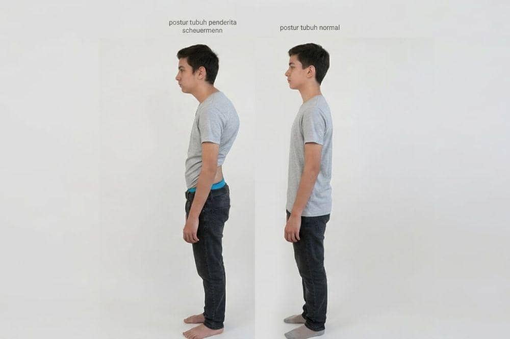 Penyebab Badan Bungkuk dan Cara Mengatasinya 3