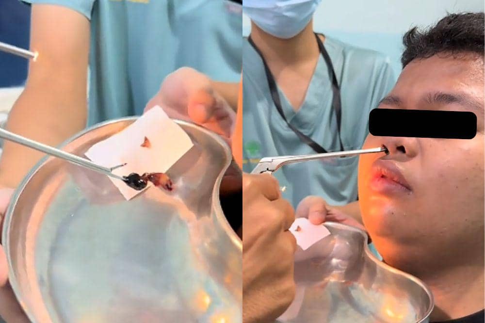 Apa itu Adenoid pada Anak? Gejala, Penyebab dan Pengobatan