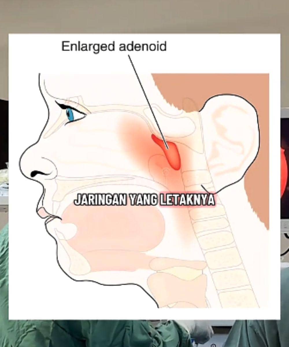 adenoid pada anak