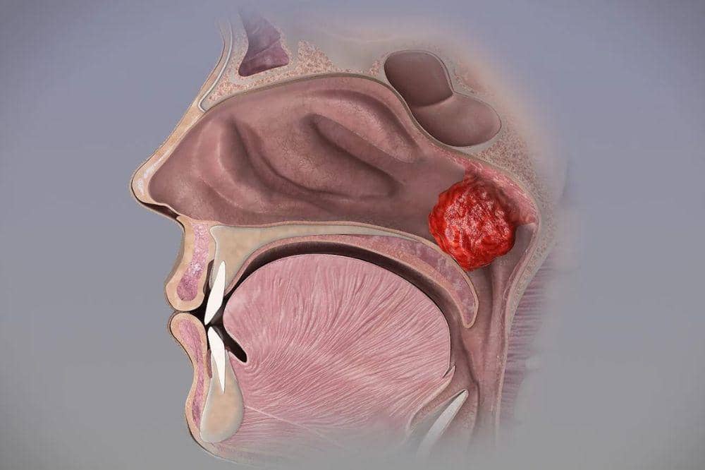 adenoid pada anak