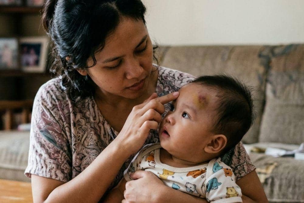 Cek lokasi lebam pada anak