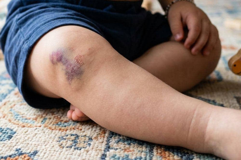 Ketahui penyebab lebam pada anak