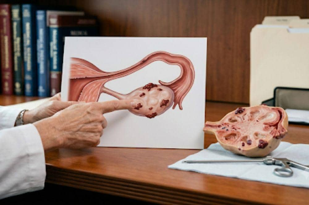 Sering Tertukar, Ini Perbedaan Endometriosis dan Adenomiosis! 2.jpg