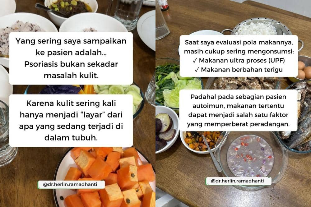 Psoriosis bukan masalah kulit biasa