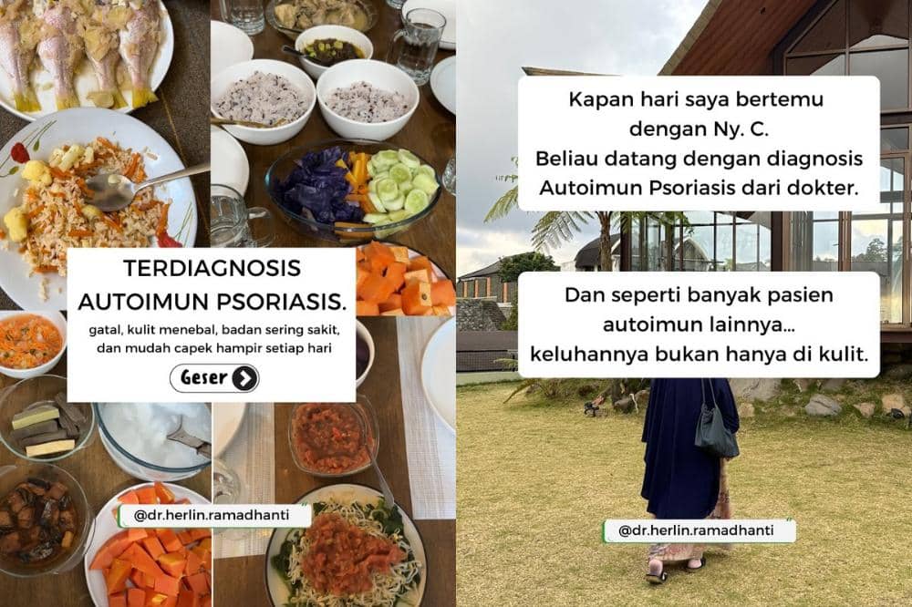 Psoriosis bukan masalah kulit biasa