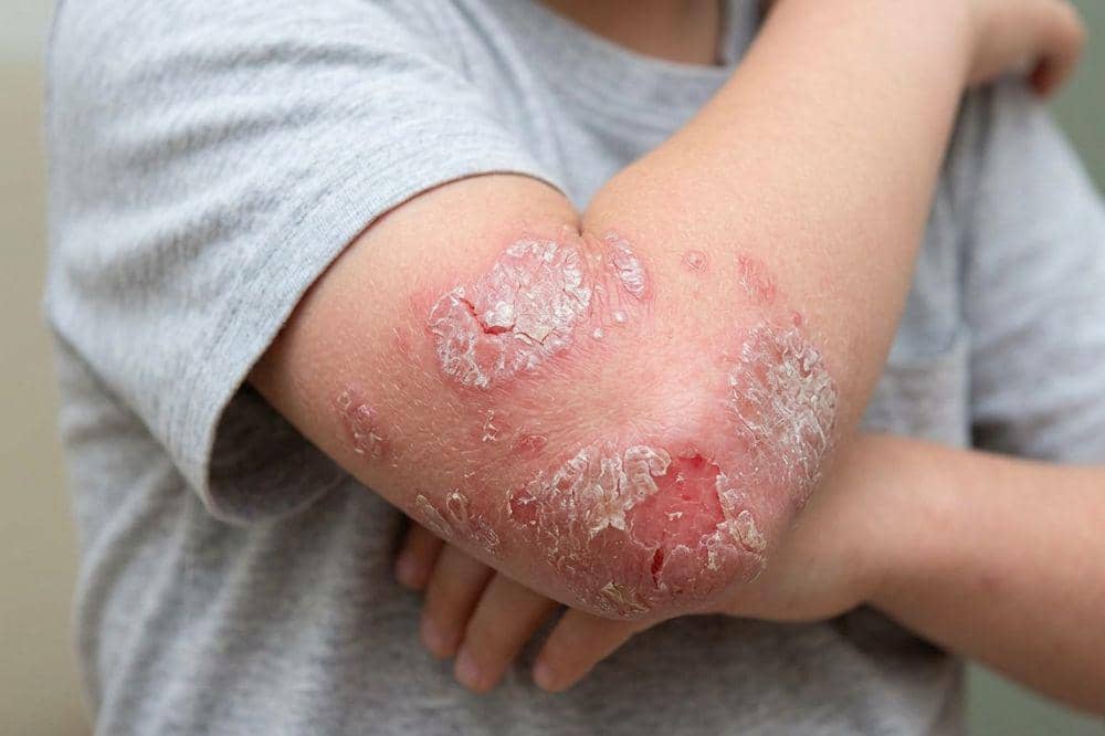 Psoriasis Bukan Masalah Kulit Biasa, Lakukan Ini agar Anak Terhindar!
