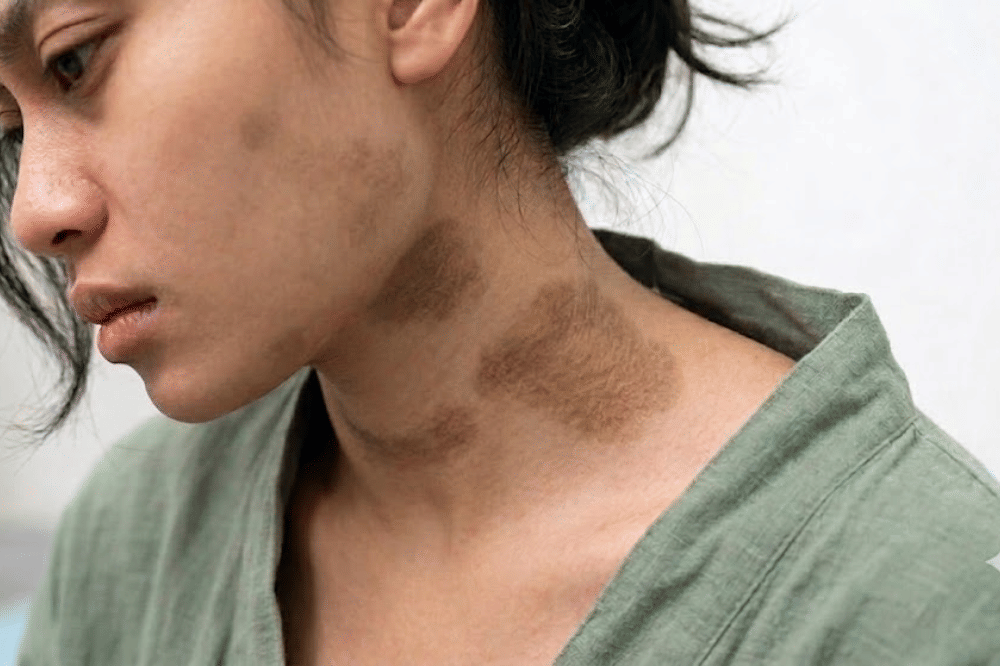 Muncul bercak kulit gelap atau skin tag