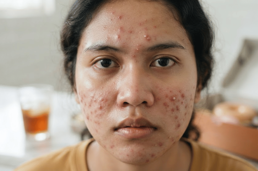 Risiko masalah kulit lainnya