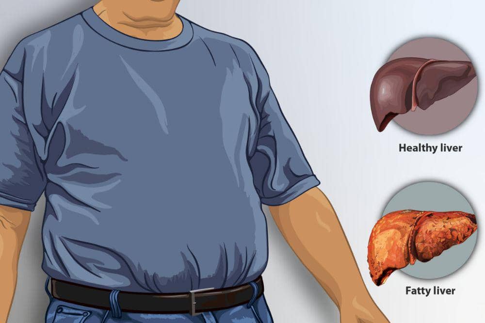Apa Itu Fatty Liver? Ini Pengertian, Gejala, dan Pengobatannya