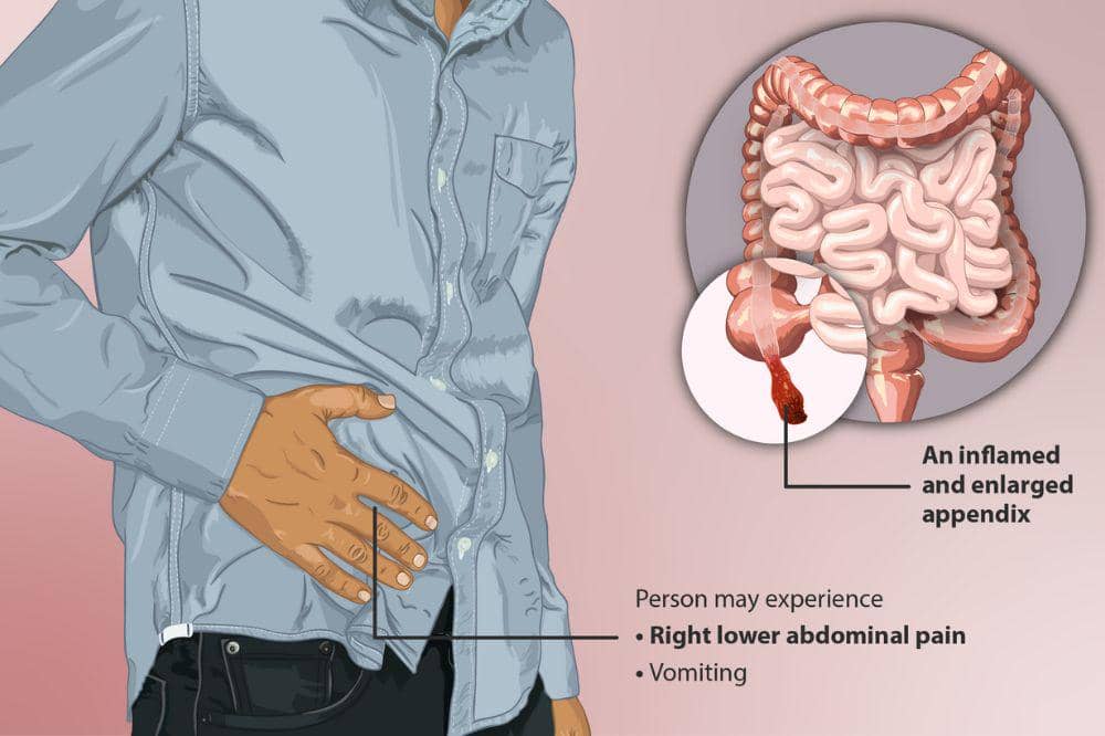 Bisakah Usus Buntu Sembuh Tanpa Operasi