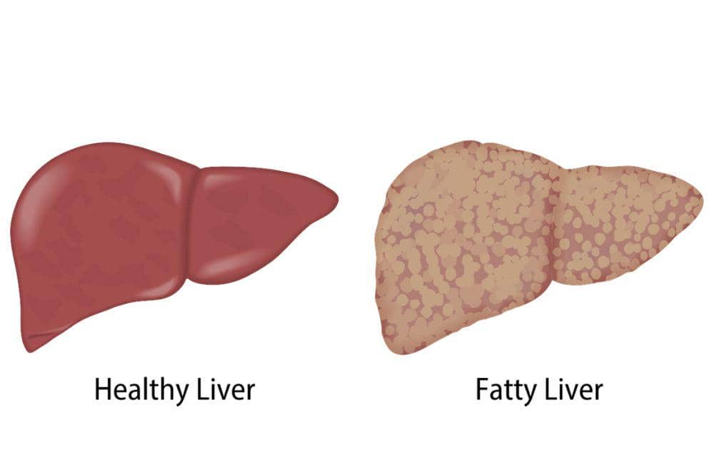 Pengertian Fatty Liver