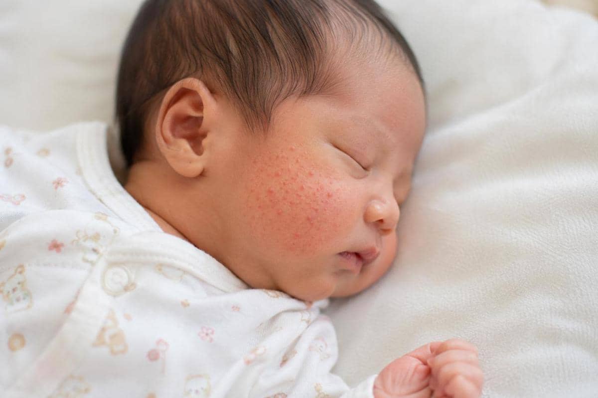 Kondisi pada bayi yang sering dikira berbahaya padahal normal