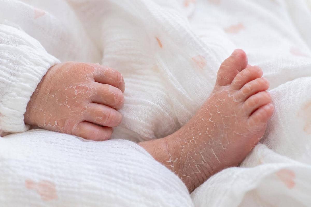 Kondisi pada bayi yang sering dikira berbahaya padahal normal